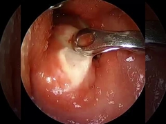 جریان ≤1.5mA آرتروسکوپی RF پلاسمای چوب تجهیزات جراحی شانه لگن زانو