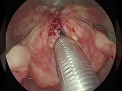 4 کانال ENT ابزار جراحی با الکترود فعال سه سیم استاندارد